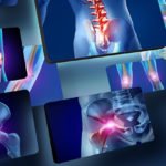 Lo sai che l’osteoporosi è transitoria se si tratta di algodistrofia?