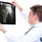 Artrosi d’anca: prevenirla con i consigli degli esperti di Anca Surgical Center