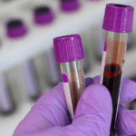 Protesi anca, perché stimare le perdite di sangue durante l’intervento?
